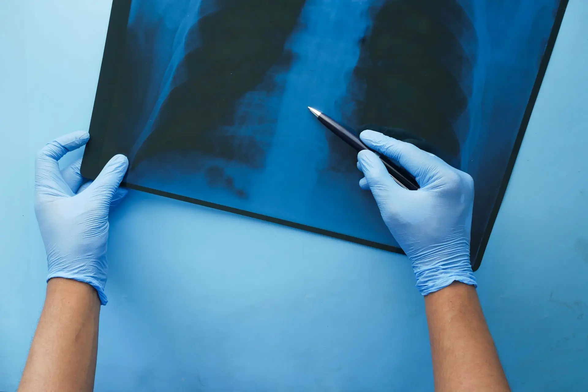 Lung Cancer Surgery: Can Lung Cancer Be Removed Without a Large Chest Incision?