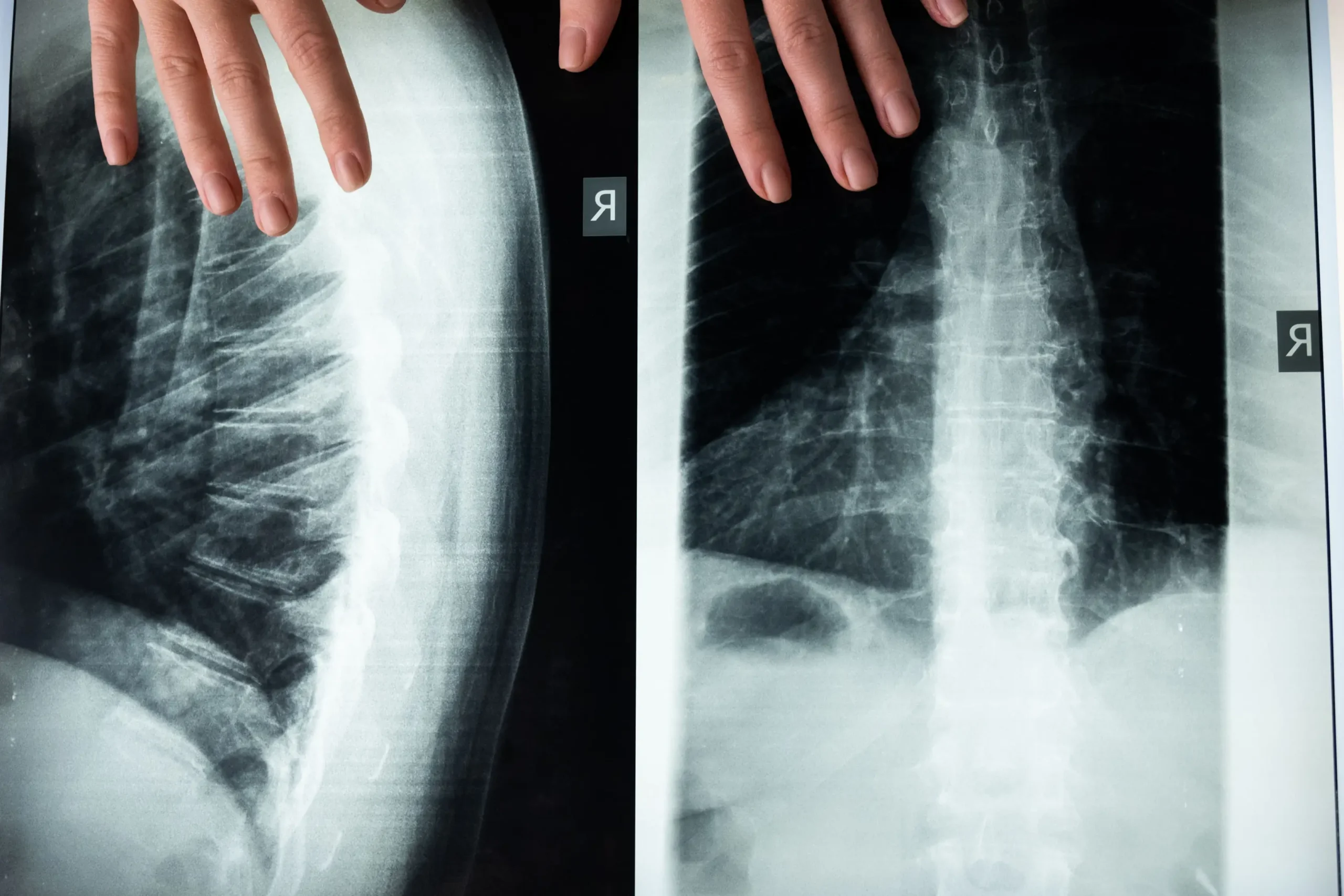 Osteoporosis in Egypt: Diagnosis, Treatment, Cost & Care Guide